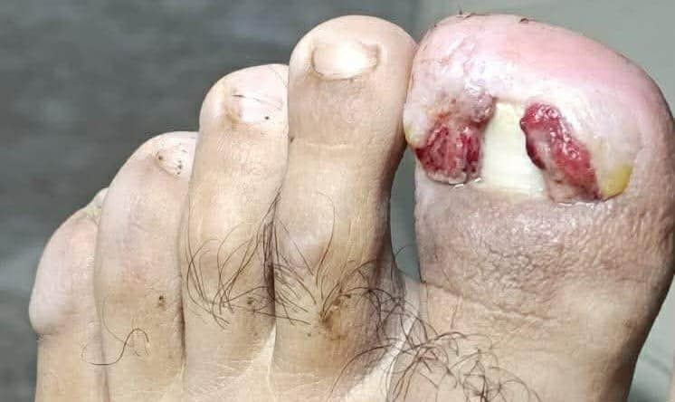 Uñeros: Por qué NUNCA debes cortarlos tú mismo